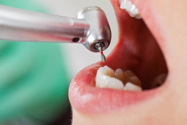 Best Emergency Tooth Extraction in Novi, MI